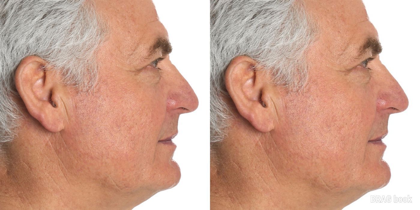 Blepharoplasty - Thumbnail 4