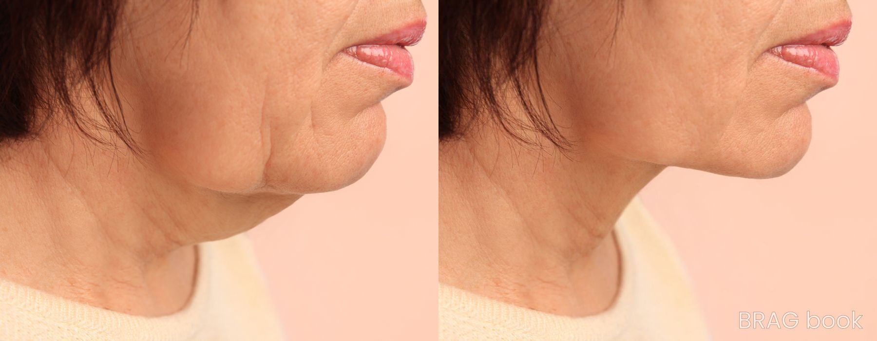 Before and after Chin Augmentation case 4775