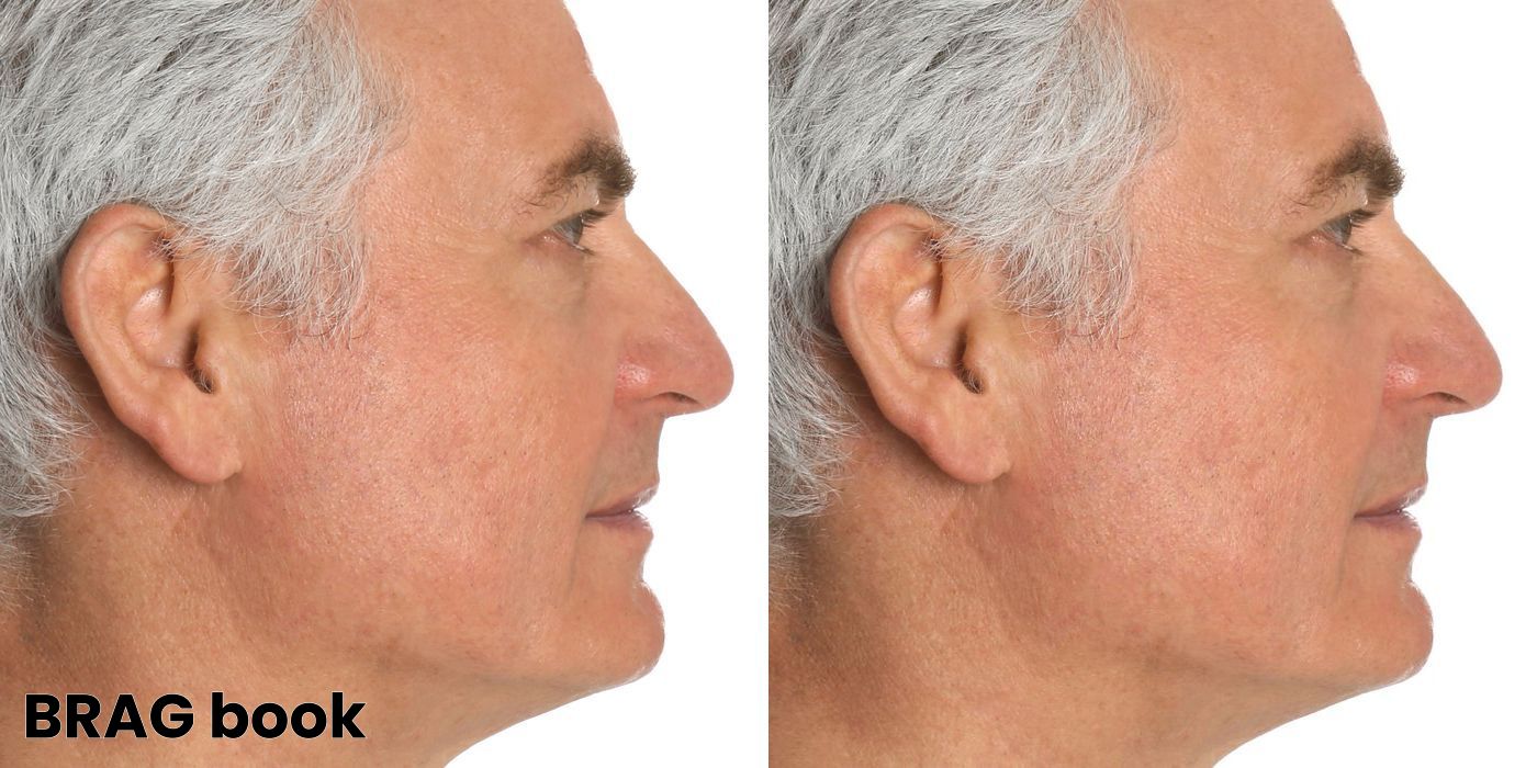 Body Lift - Case 1985