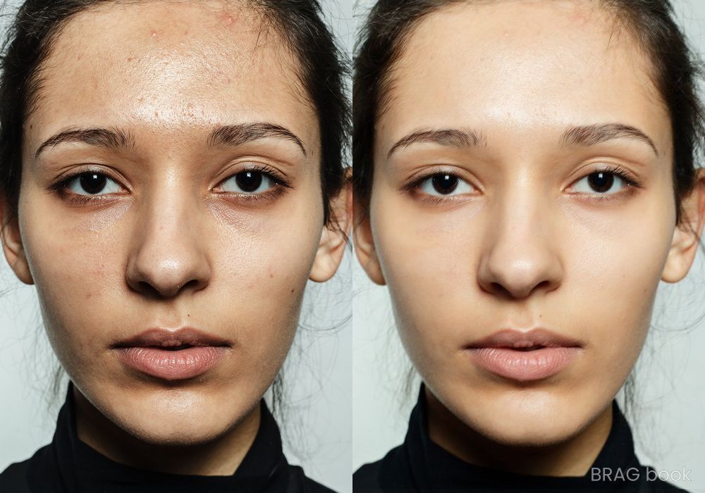 Before and after Laser Skin Resurfacing case 4767