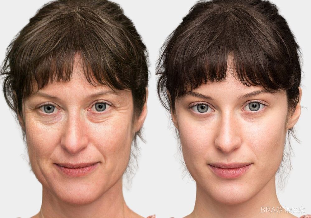 Before and after Laser Skin Resurfacing case 4750