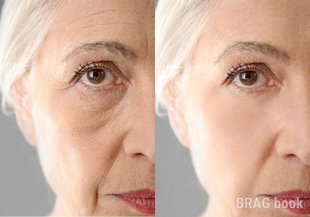 BOTOX Cosmetic - Case 1886