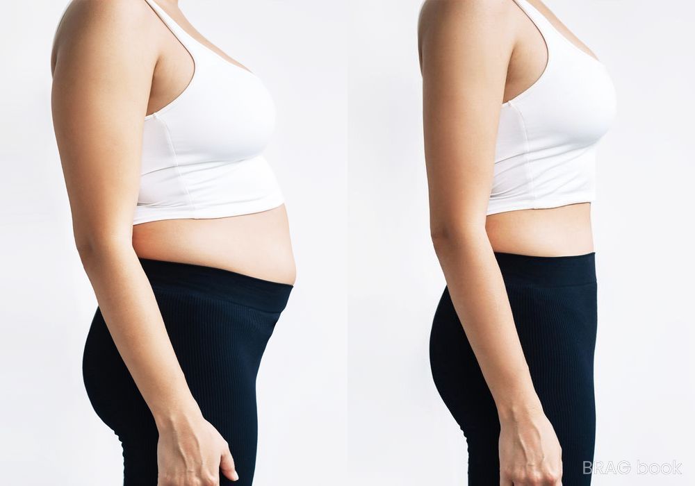 Before and after Liposuction case 4798 - Angle 2
