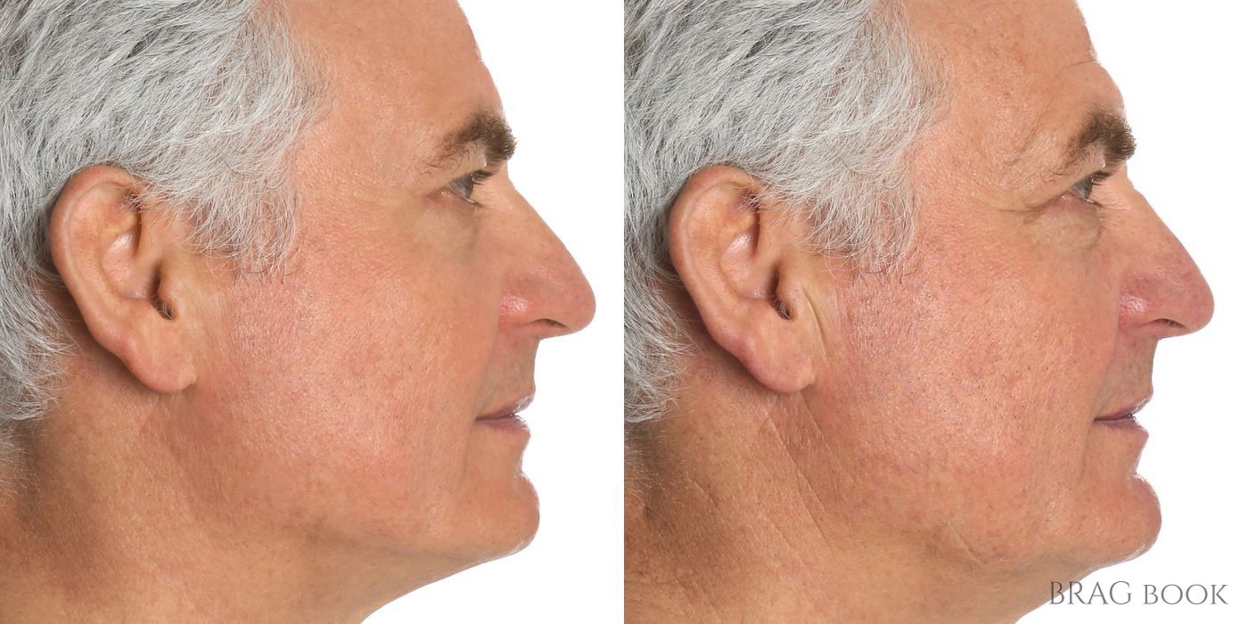 Double Chin - Kybella - Case 2004