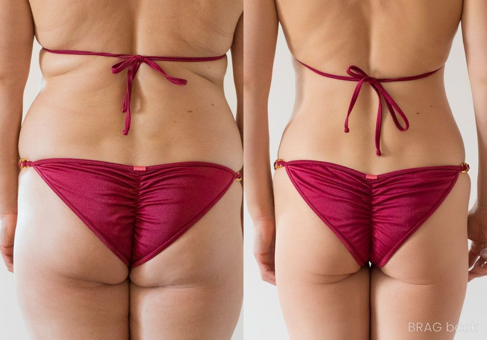 Before and after Liposuction case 23819 - Angle 3
