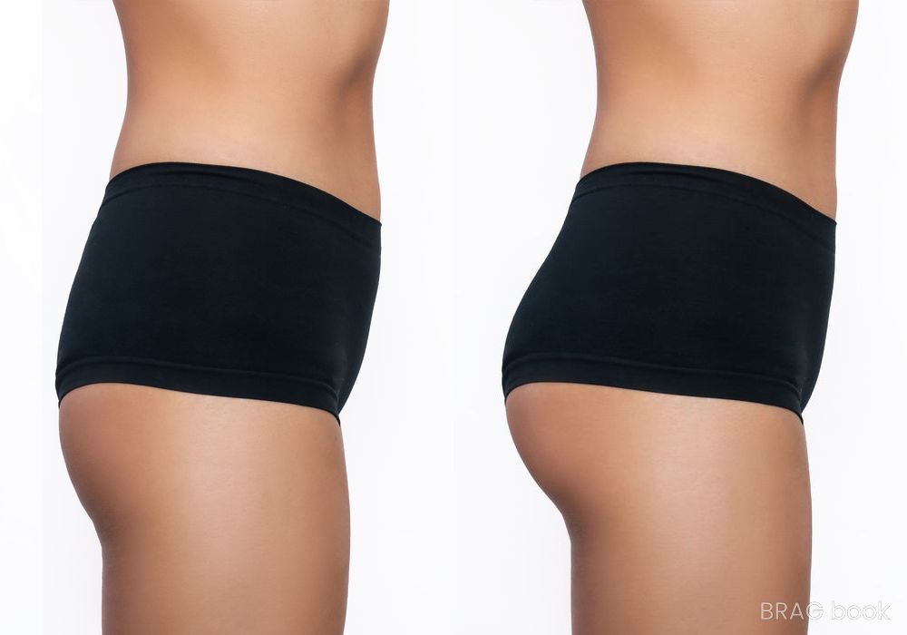 Before and after Brazilian Butt Lift case 4786
