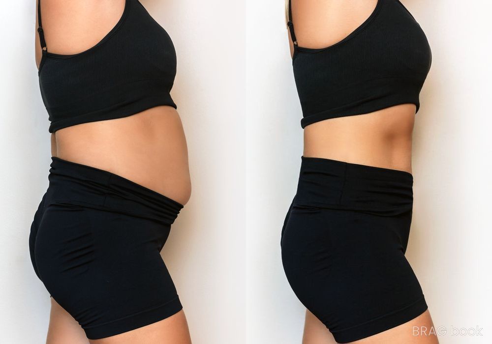 Before and after Liposuction case 4763