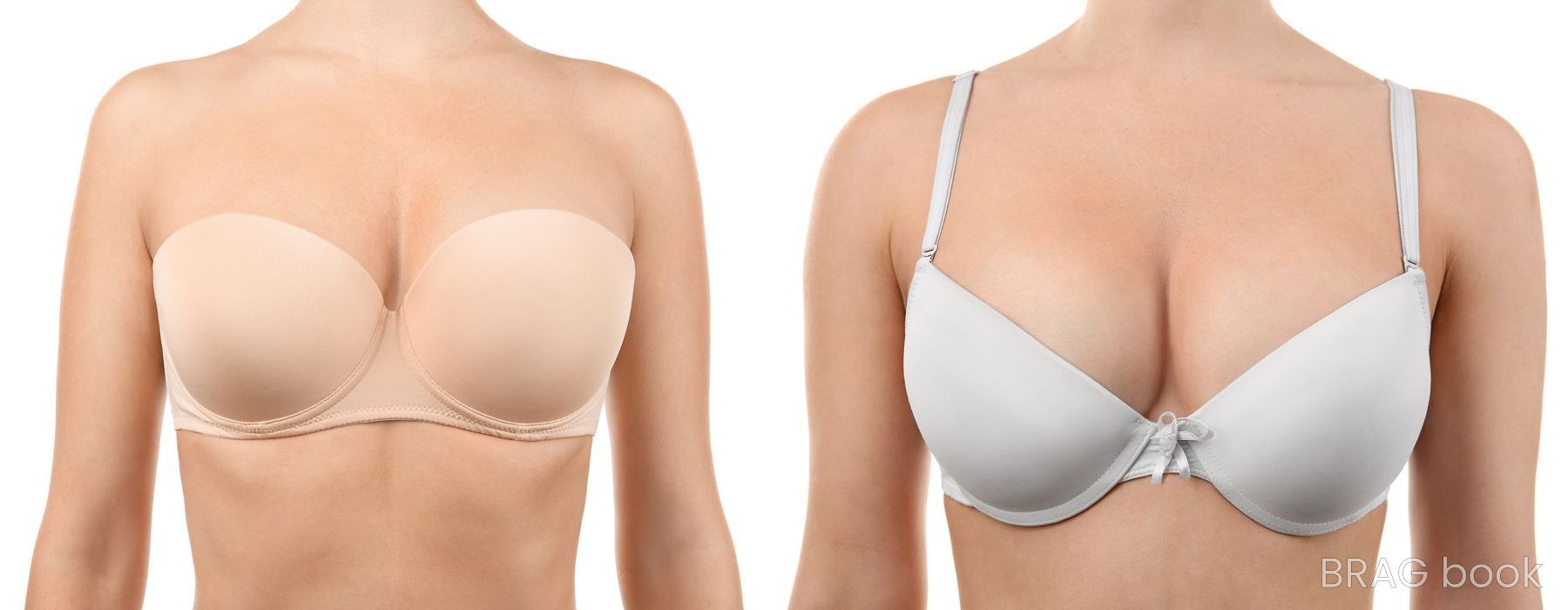 Before and after Tummy Tuck case 23912