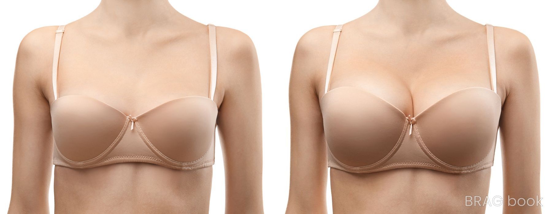 Before and after Breast Augmentation case 4785