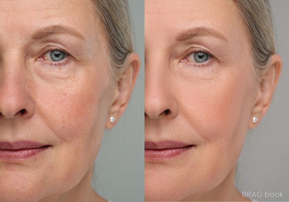 Before and after Photorejuvenation case 4769