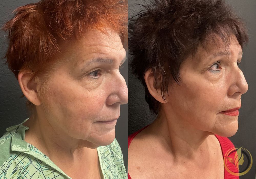 Facelift & Neck Lift - Thumbnail 2