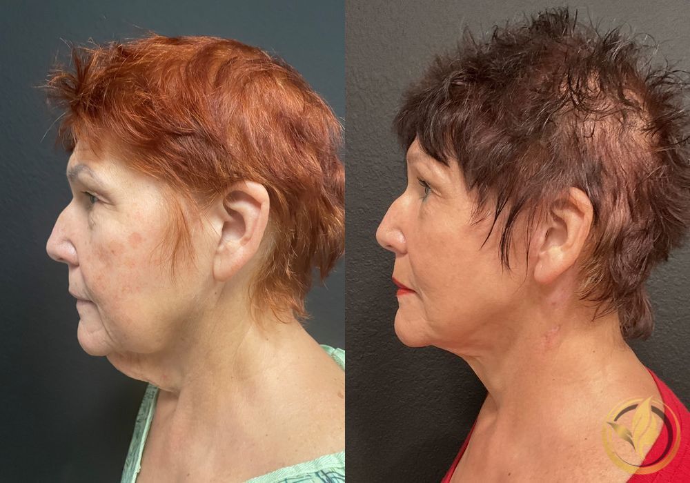 Facelift & Neck Lift - Thumbnail 5