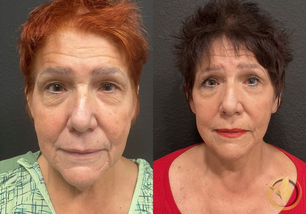 Facelift & Neck Lift - Case 1473
