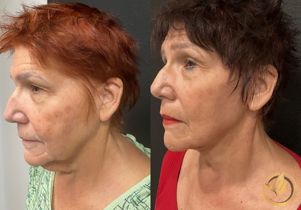 Facelift & Neck Lift - Thumbnail 3