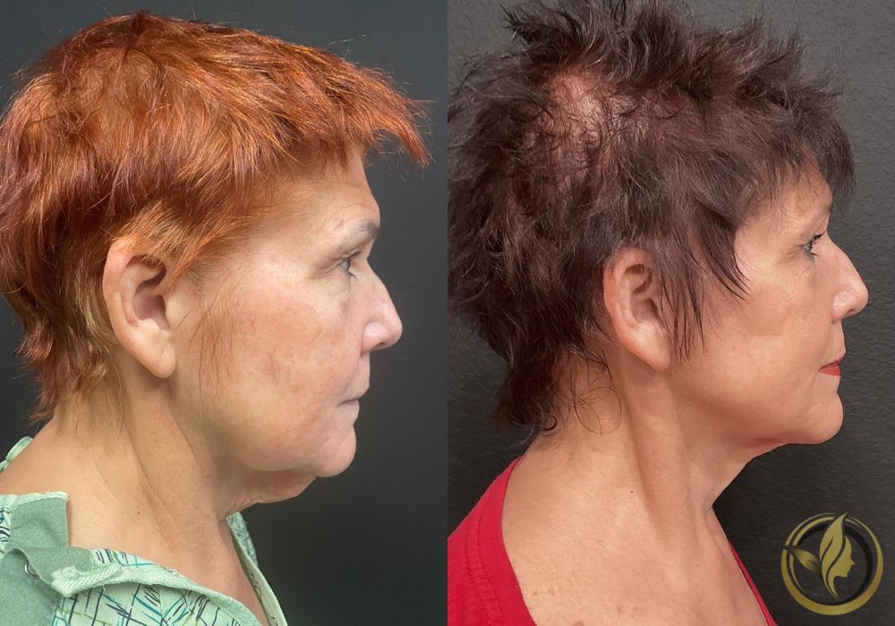 Facelift & Neck Lift - Thumbnail 4