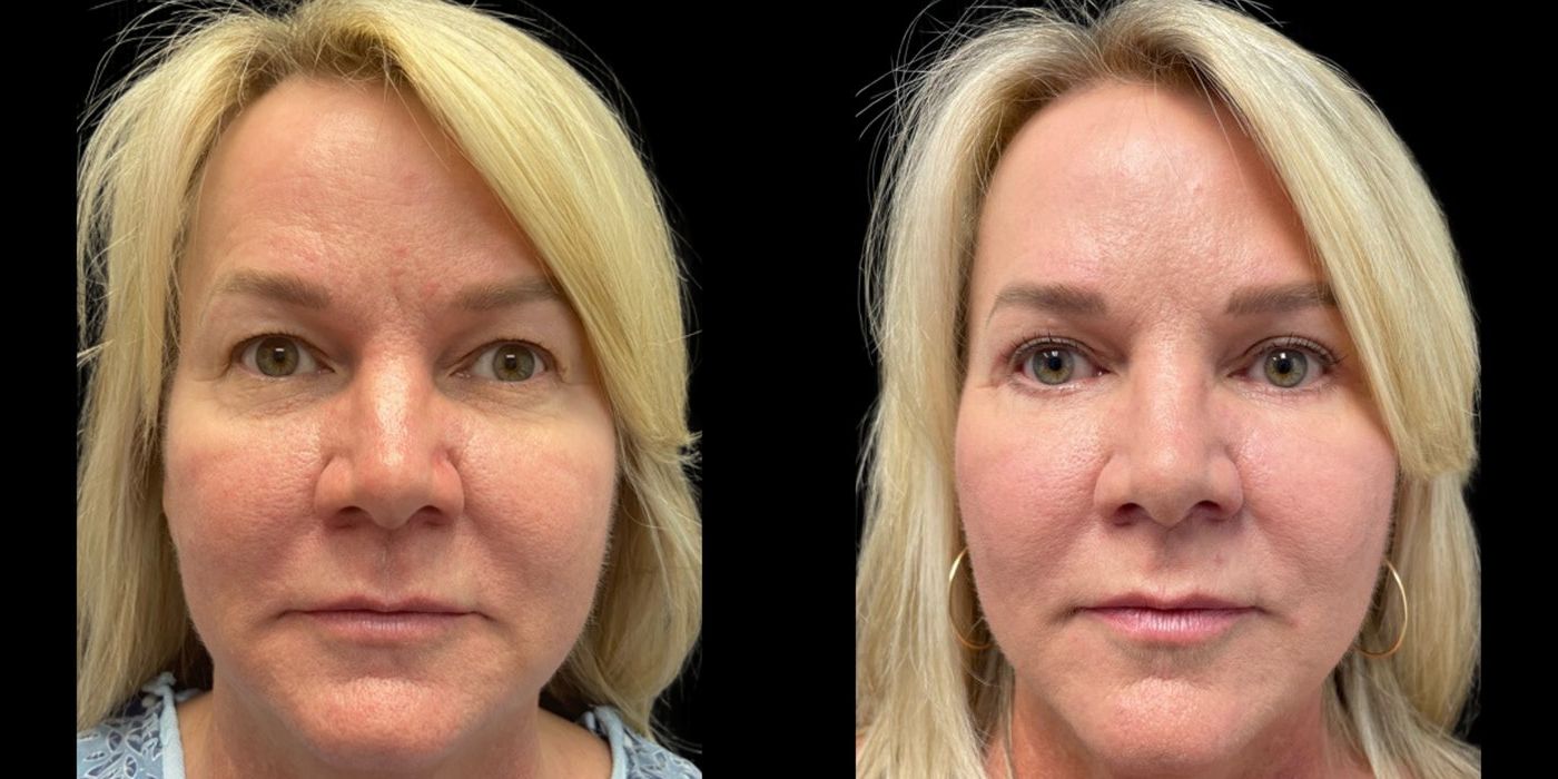 Before and after procedure result