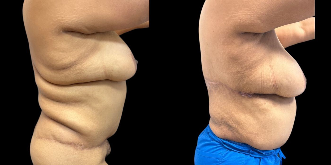 Before and after procedure result