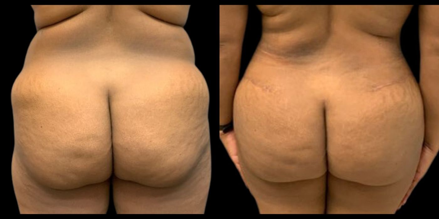 Before and after procedure result