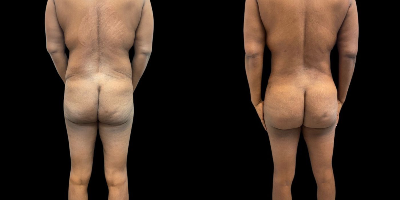 Before and after procedure result