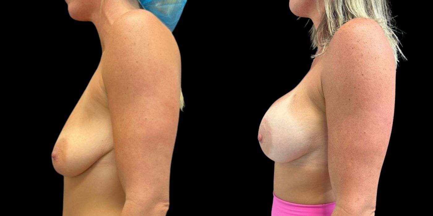 Breast Augmentation - Case 240760