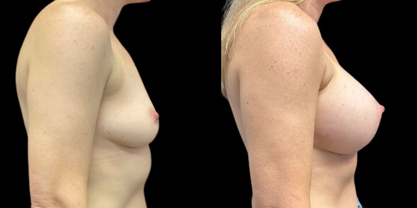 Breast Augmentation - Case 240757