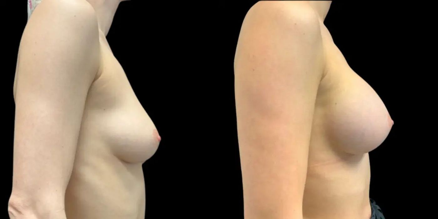 Breast Augmentation - Thumbnail 3