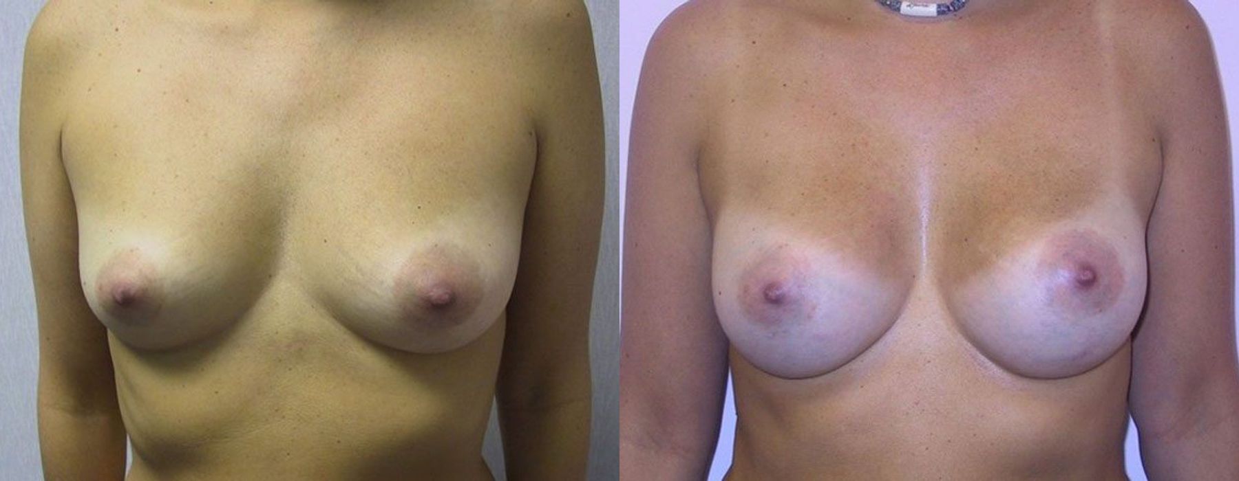 Before and after procedure result