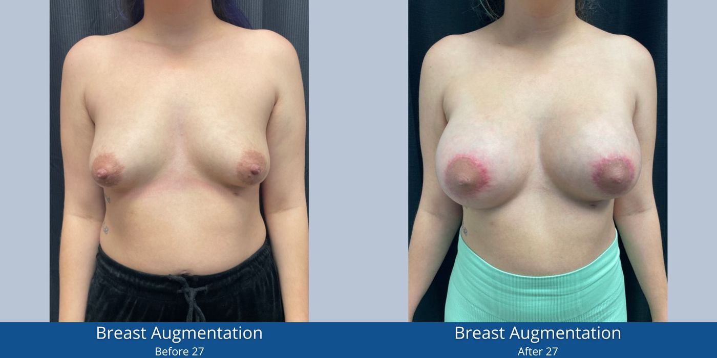 Breast Augmentation - Case 240744