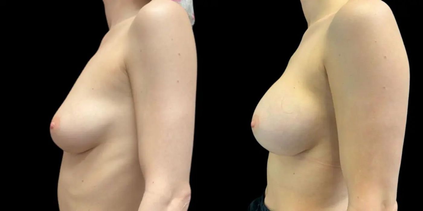 Breast Augmentation - Thumbnail 2