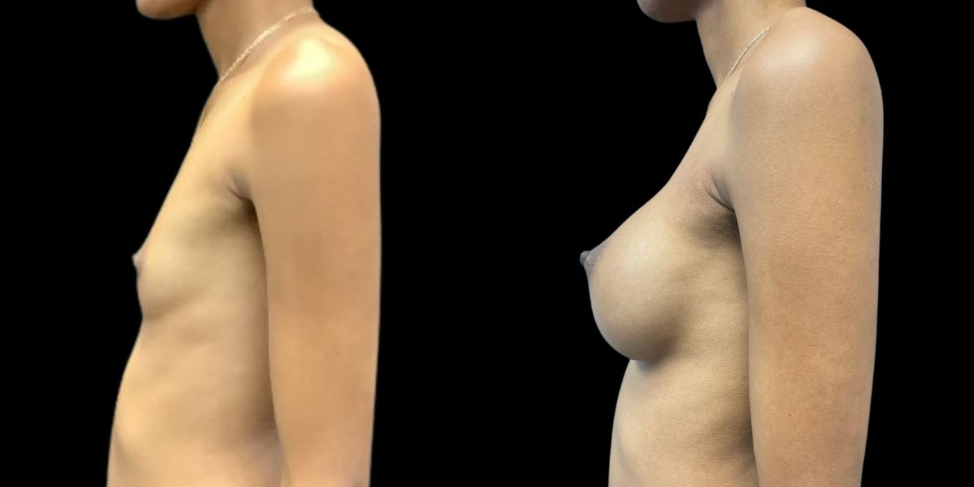 Breast Augmentation - Case 240753