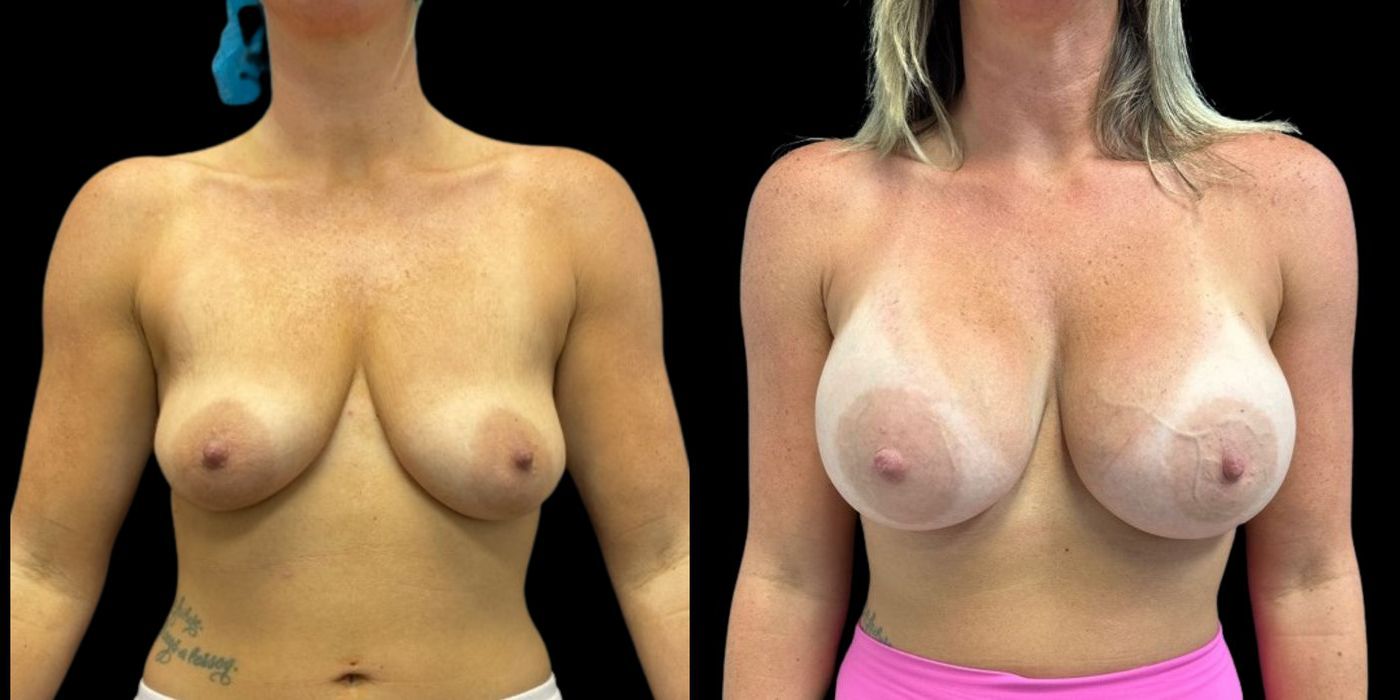 Breast Augmentation - Case 240759