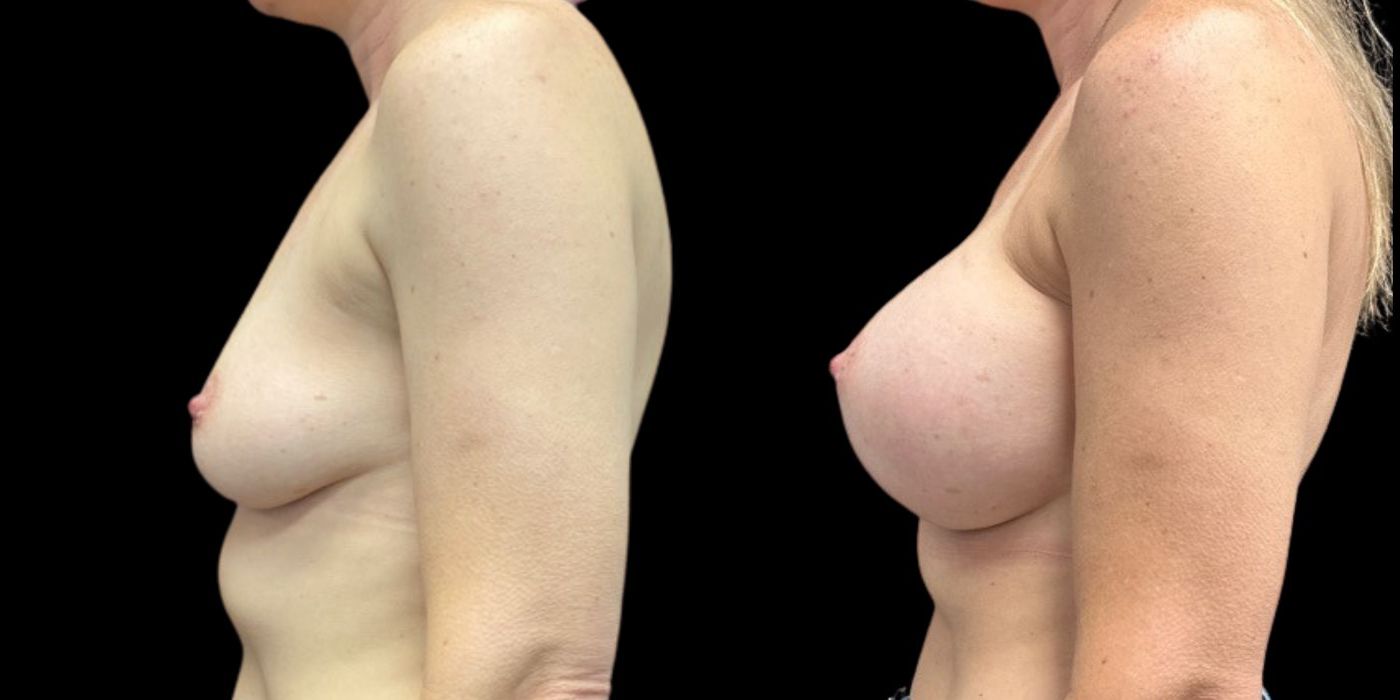 Breast Augmentation - Case 240758