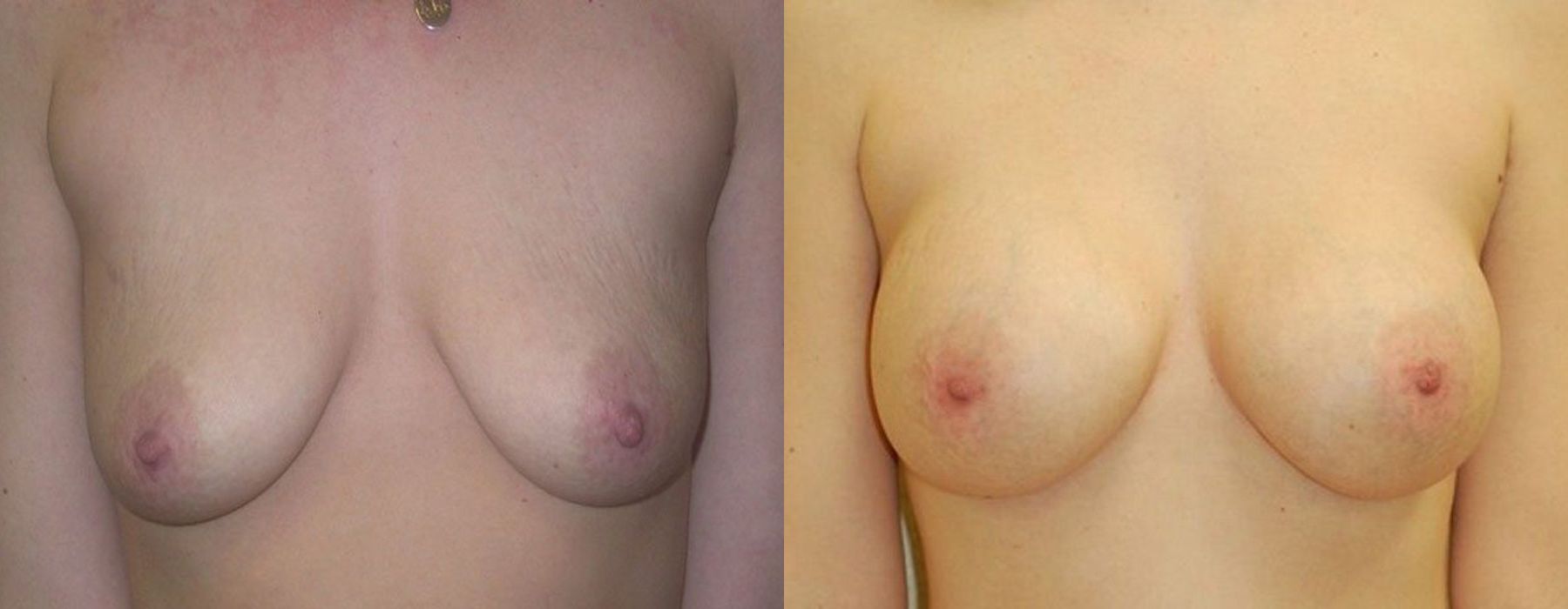 Breast Augmentation - Case 240731