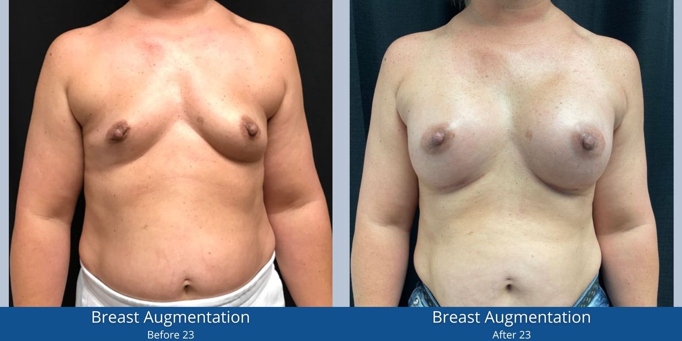 Breast Augmentation - Case 240745