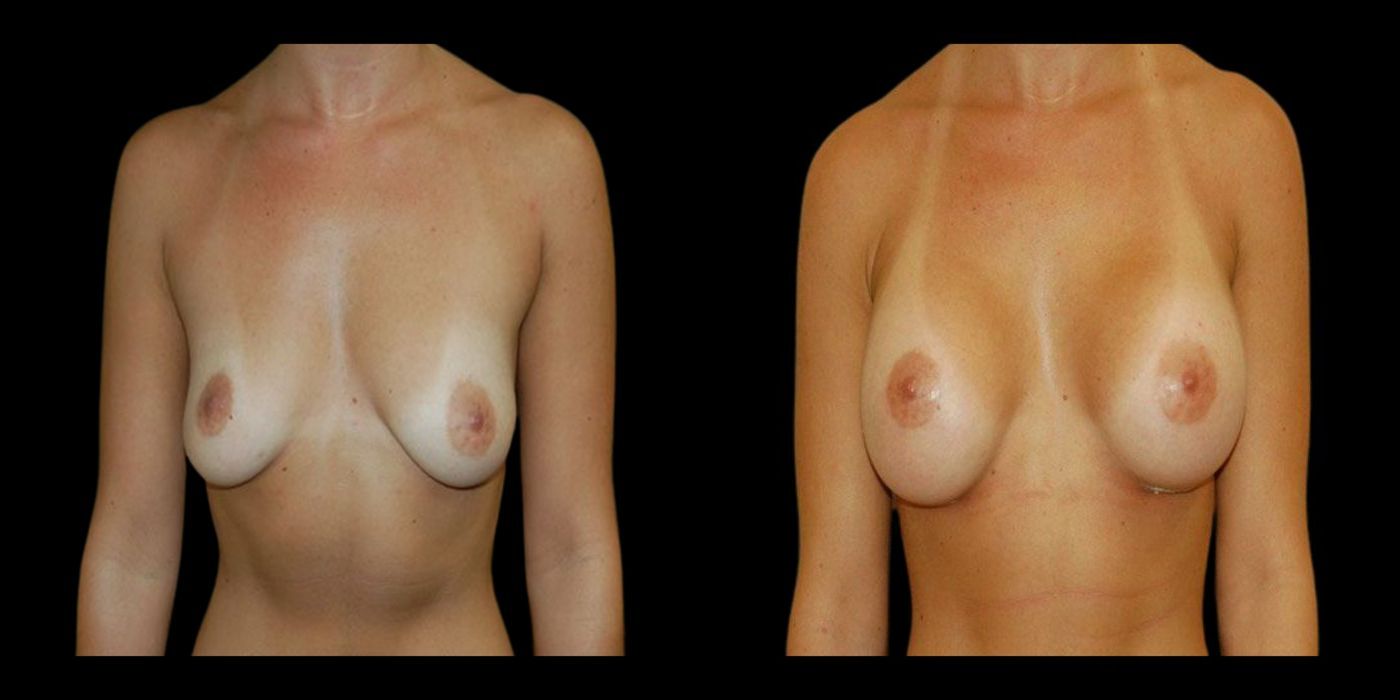 Breast Augmentation - Case 240769