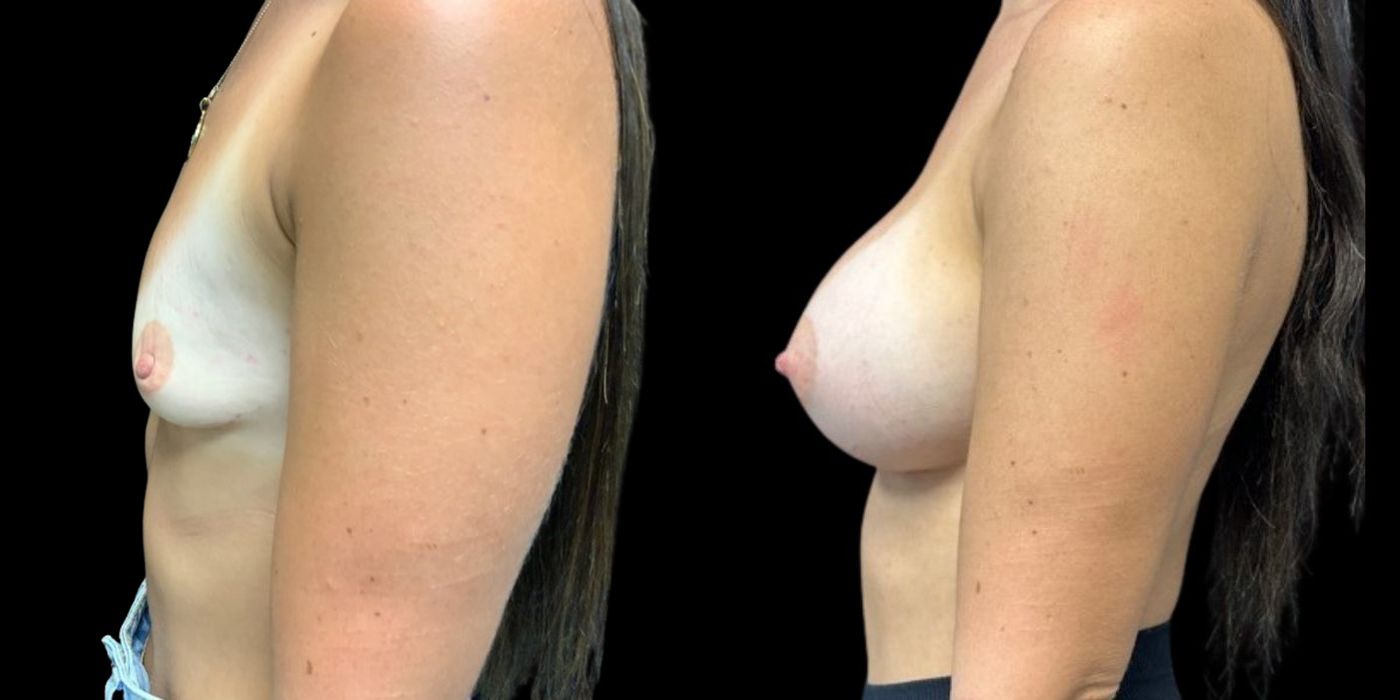 Breast Augmentation - Case 240762