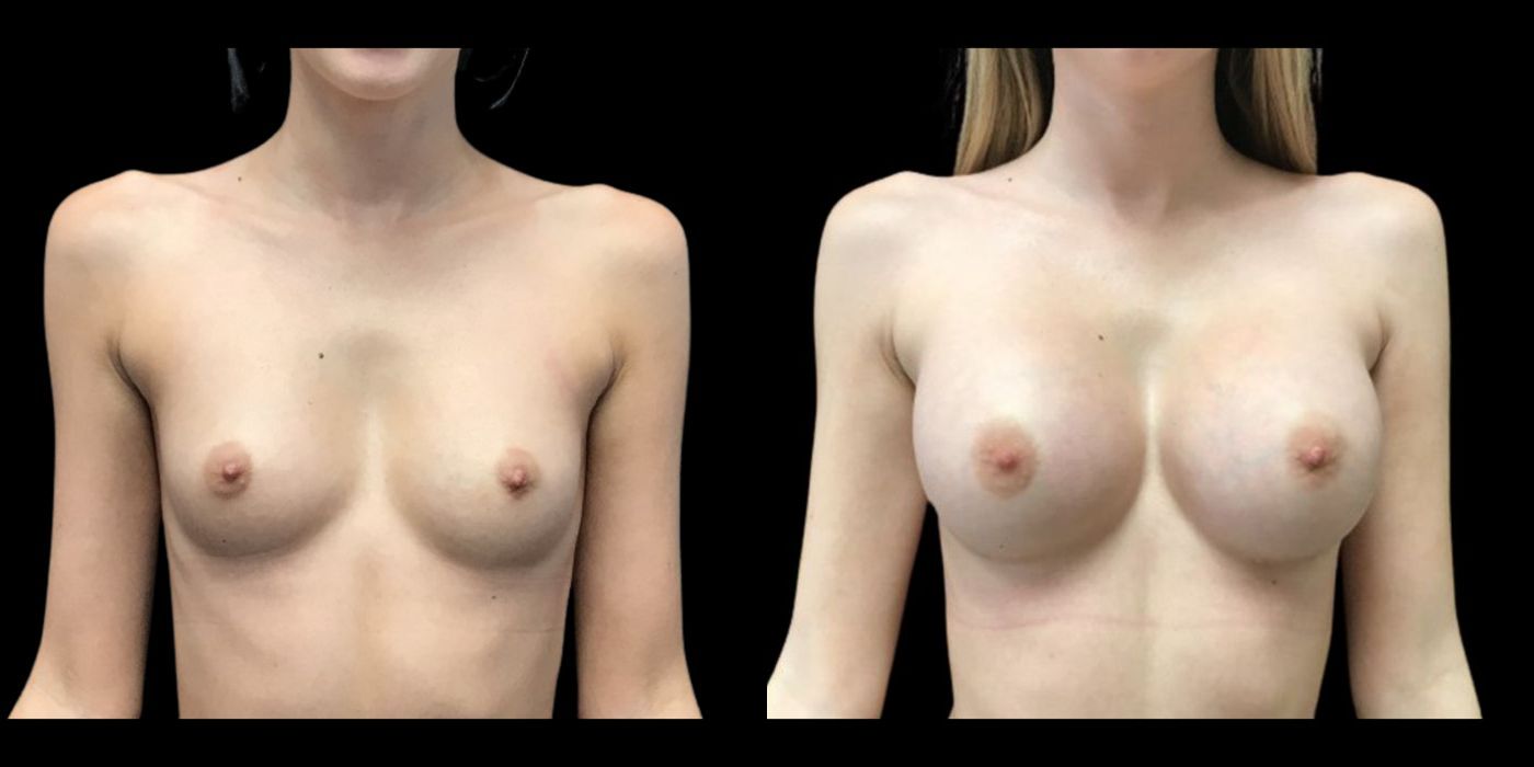 Breast Augmentation - Case 240768