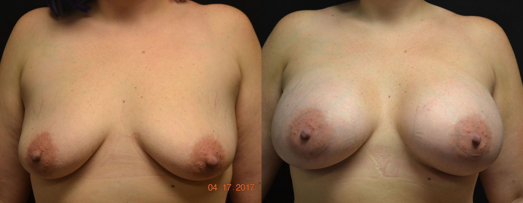 Breast Augmentation - Case 240736