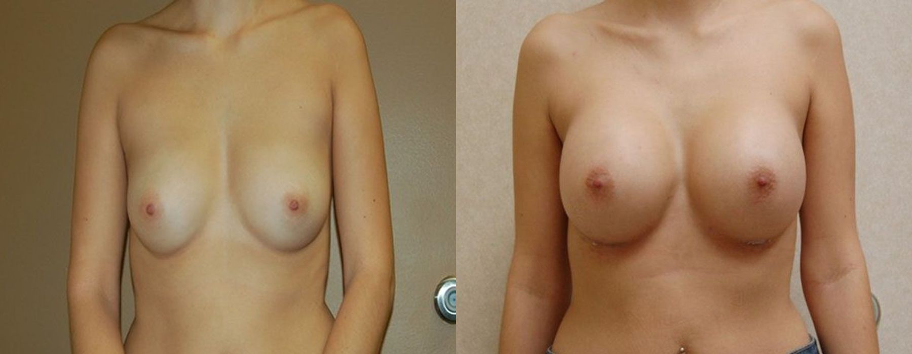 Before and after procedure result