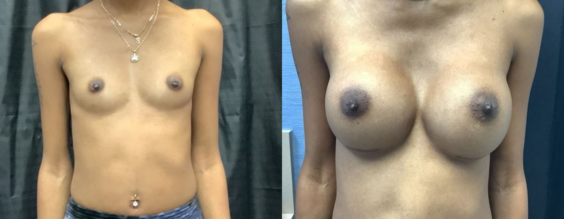 Breast Augmentation - Case 240746