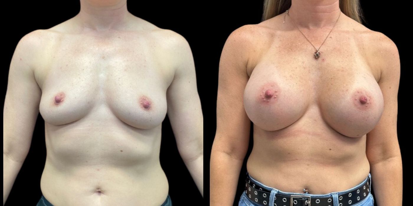 Breast Augmentation - Case 240756
