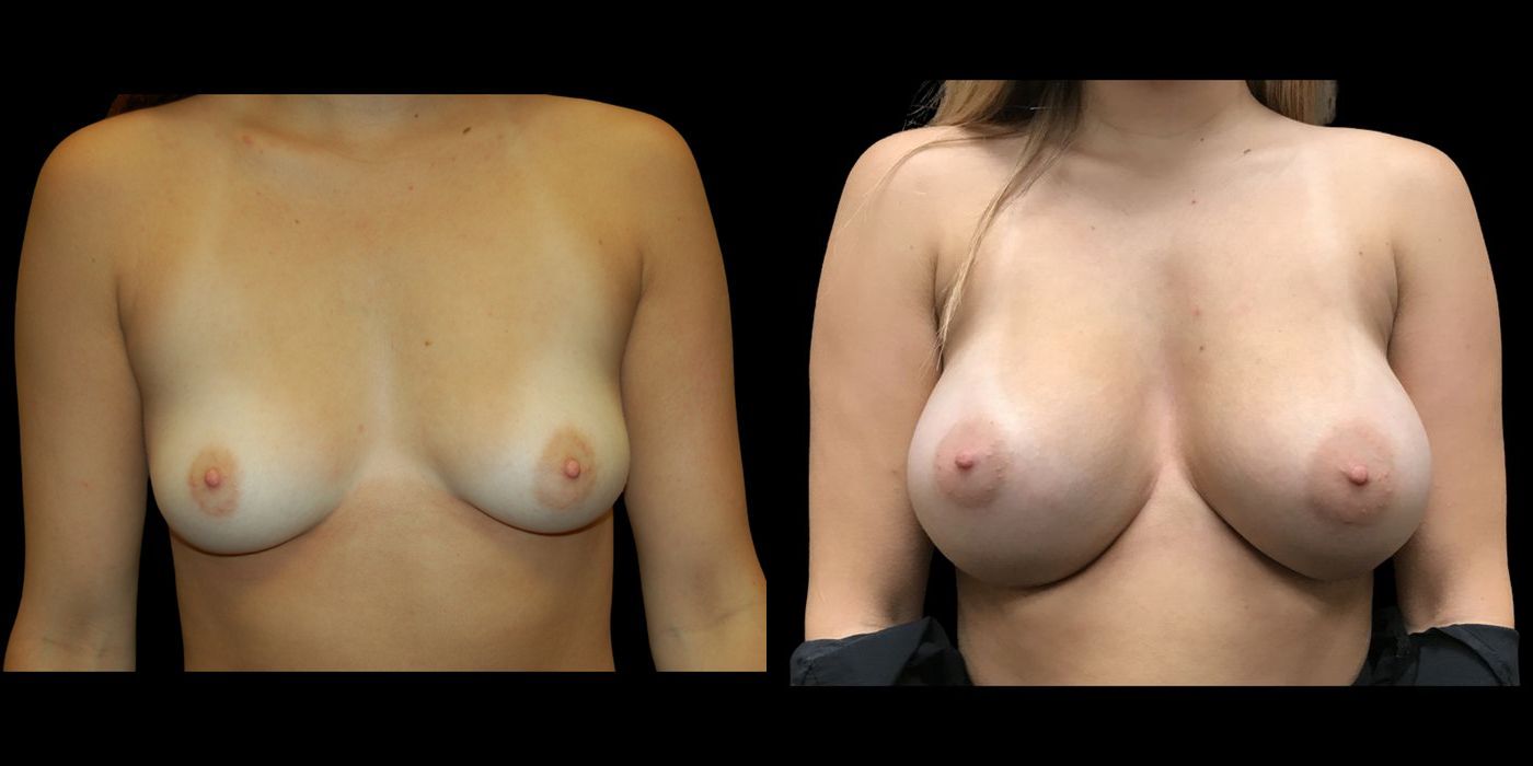 Breast Augmentation - Case 240770