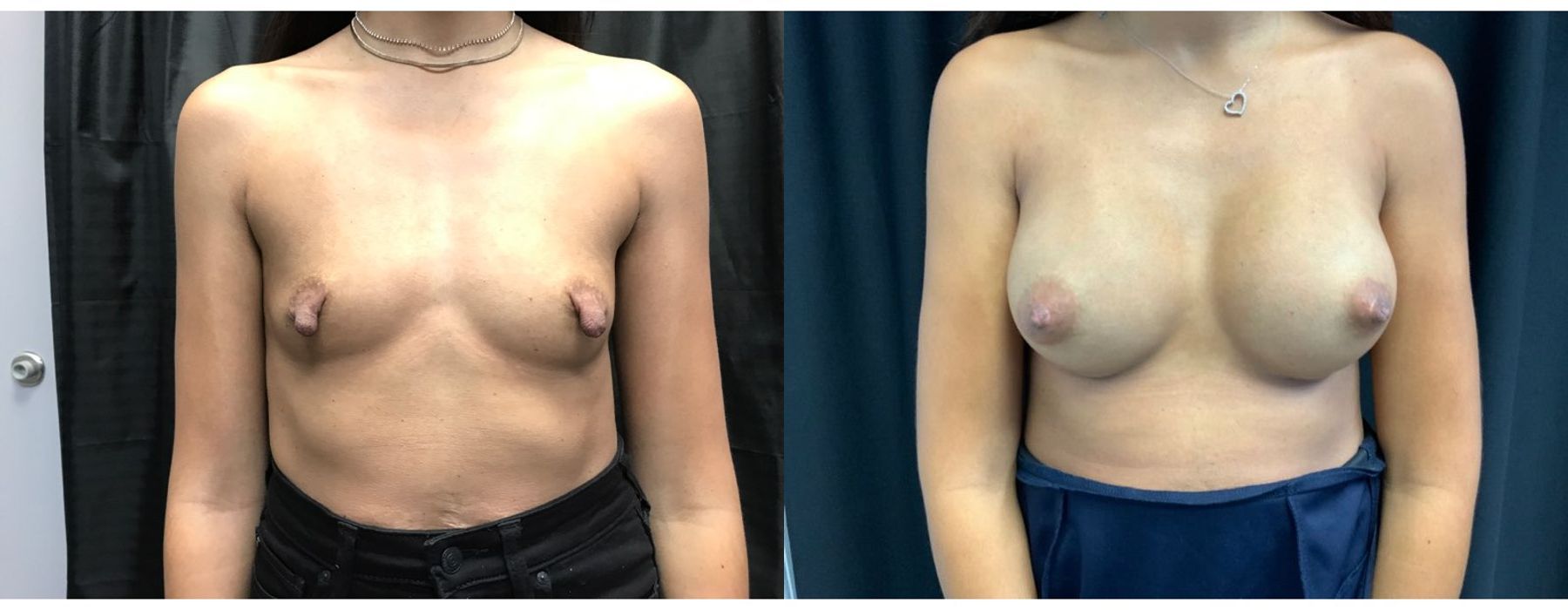 Breast Augmentation - Case 240743