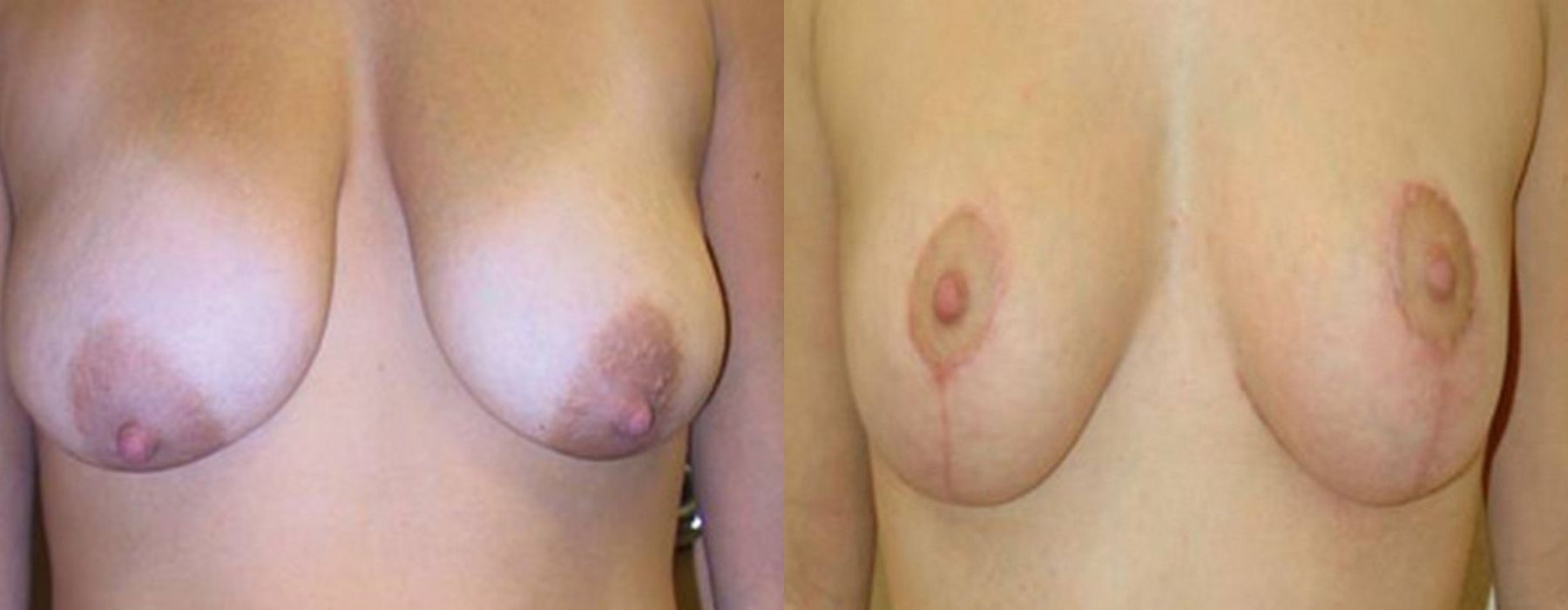 Before and after procedure result