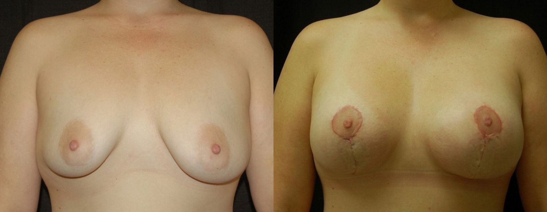 Before and after procedure result