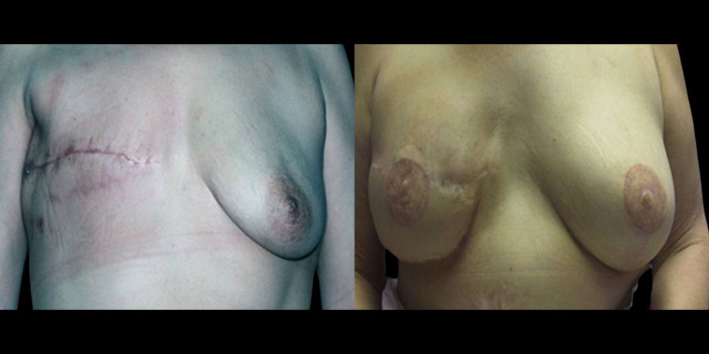 Before and after procedure result