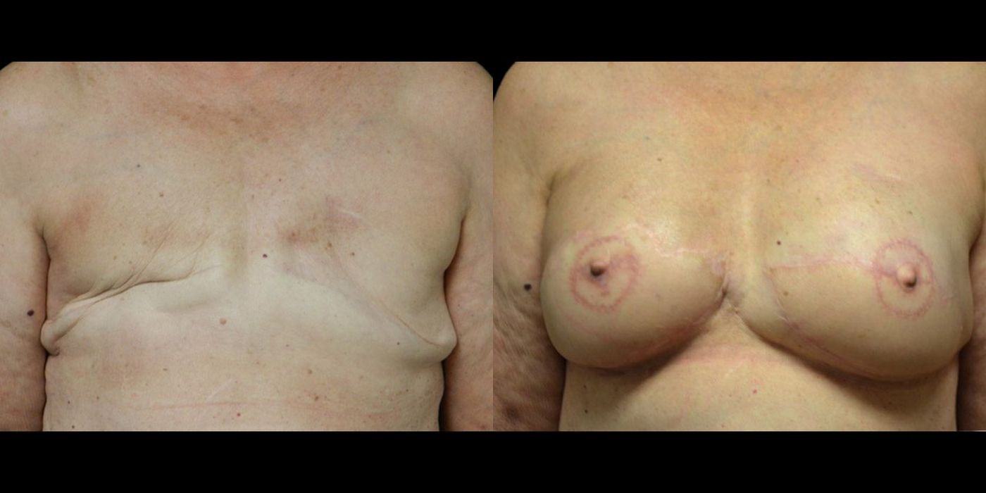 Before and after procedure result