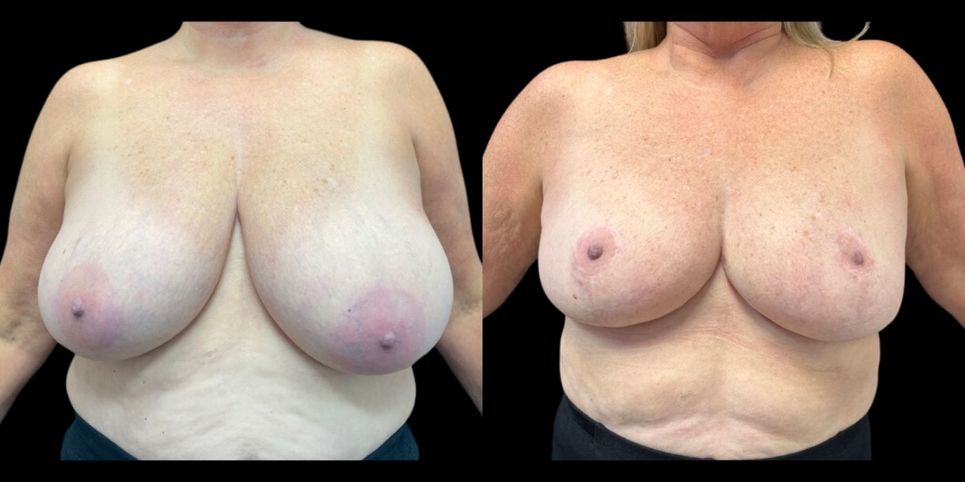 Before and after procedure result