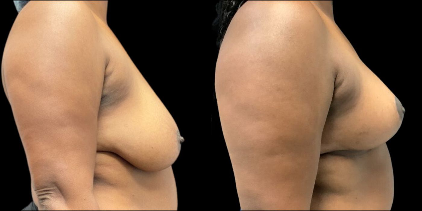 Before and after procedure result