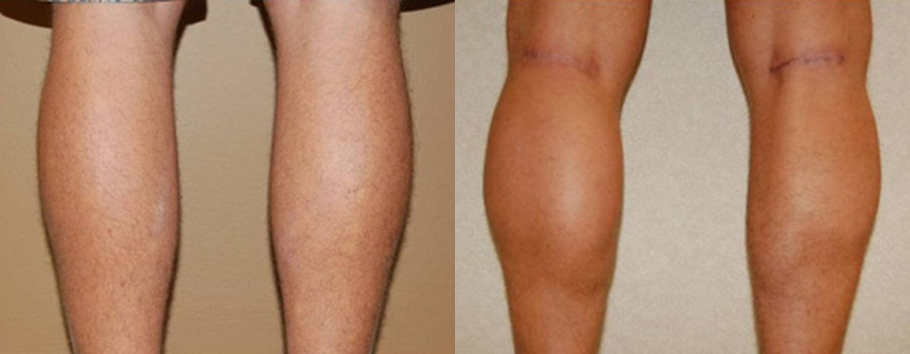 Before and after procedure result